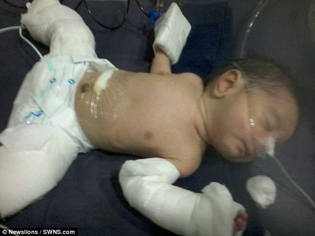 A baby boy (pictured) was born 'pregnant' - with his own twin brother, but is now doing well