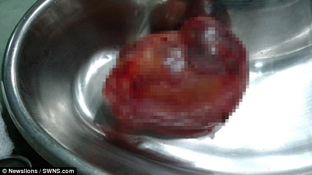 The condition can cause death if the fully-formed baby is starved of nutrition in the womb