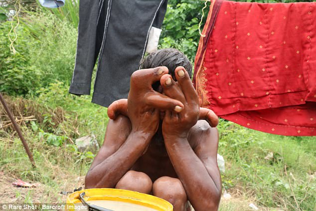 His big hands mean he struggles to do daily tasks and is dependent on his family for help