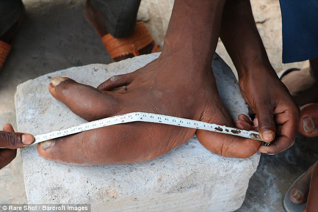 Tarik has had big hands since birth, which doctors speculate may be  Elephant Foot disease