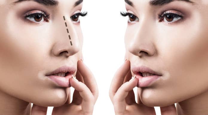 تجميل الأنف بالخيوط مميزات عملية تجميل الأنف بالخيوط