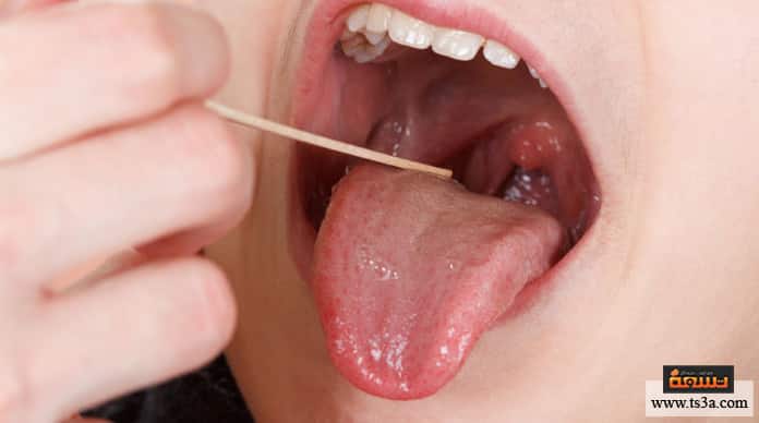 d8aad982d8b1d8add8a7d8aa-d8a7d984d984d8b3d8a7d986-d8aad982d8b1d8add8a7d8aa-d8a7d984d984d8b3d8a7d986-d8a7d984d985d8b2d985d986d8a9 تقرحات اللسان تقرحات اللسان المزمنة