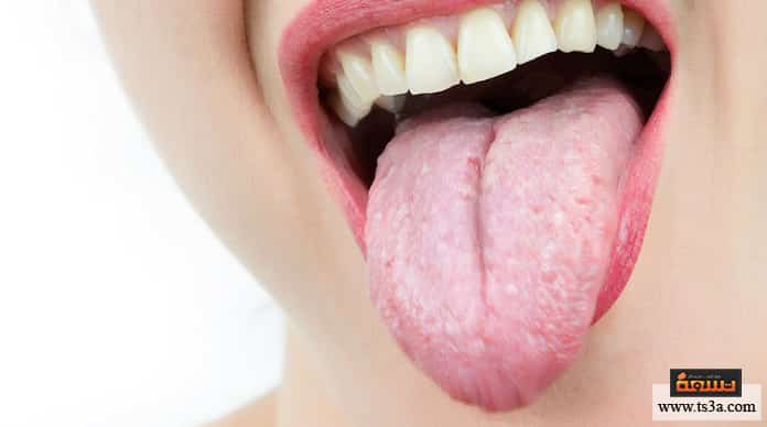 d8acd981d8a7d981-d8a7d984d984d8b3d8a7d986-d8acd981d8a7d981-d8a7d984d984d8b3d8a7d986-d988d8a8d98ad8a7d8b6d987 جفاف اللسان جفاف اللسان وبياضه