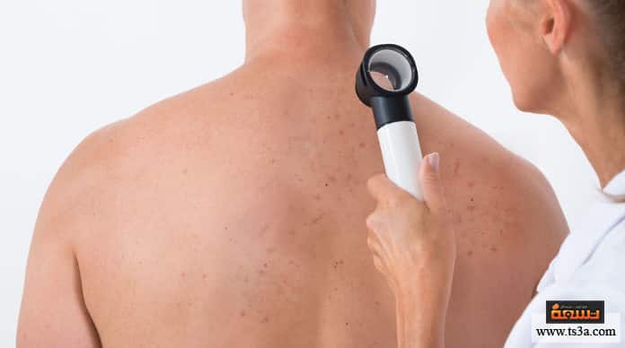 d8add8a8d988d8a8-d8a7d984d8b8d987d8b1-d8a3d986d988d8a7d8b9-d8add8a8d988d8a8-d8a7d984d8b8d987d8b1-d8a7d984d985d8aed8aad984d981d8a9 حبوب الظهر أنواع حبوب الظهر المختلفة