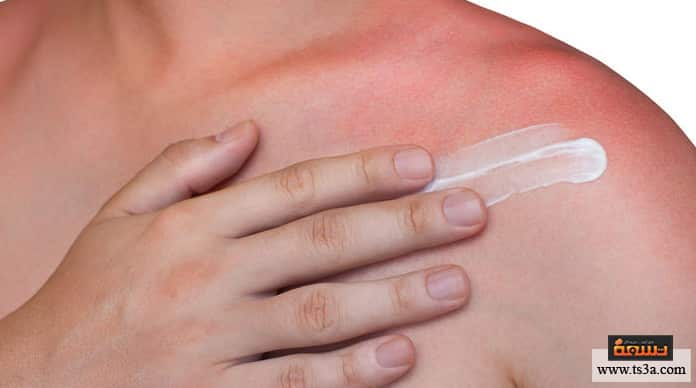 حروق الدرجة الثانية علاج الحروق البسيطة