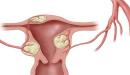 طرق علاج ميلان الرحم طرق علاج ميلان الرحم