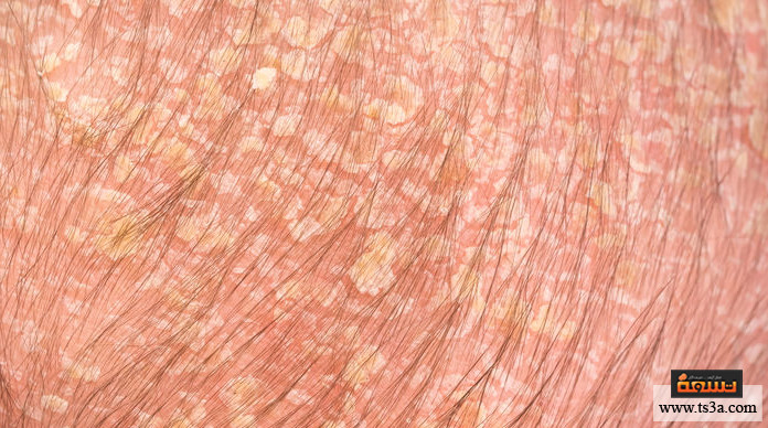 d8b9d8afd988d989-d8a7d984d8acd8b1d8a8-d8a3d8b3d8a8d8a7d8a8-d8a7d984d8acd8b1d8a8 عدوى الجرب أسباب الجرب