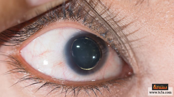 d985d8aad984d8a7d8b2d985d8a9-d985d8a7d8b1d981d8a7d986-d8a3d8b9d8b1d8a7d8b6-d985d8aad984d8a7d8b2d985d8a9-d985d8a7d8b1d981d8a7d986 متلازمة مارفان أعراض متلازمة مارفان