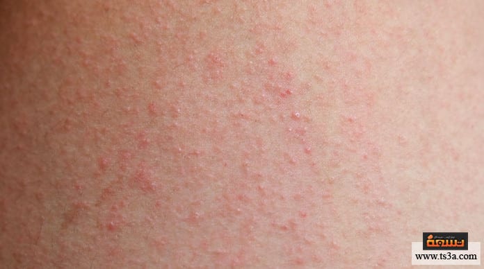 مرض الوردية مرض الوردية عند الأطفال