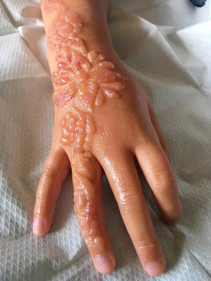 After arriving home from holidays in Egypt, Madison complained her temporary tattoo was itchy and it soon began to blister