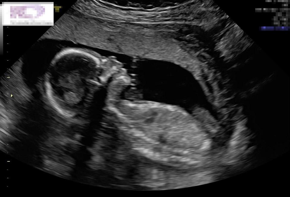 When the family went in for their baby scan, the staff were so excited when they saw the high five picture