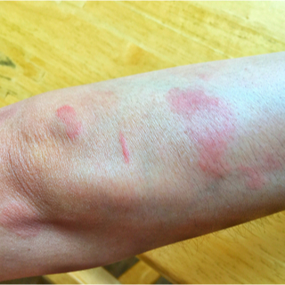 أعراض مرض الذئبة الحمراء أعراض مرض الذئبة الحمراء