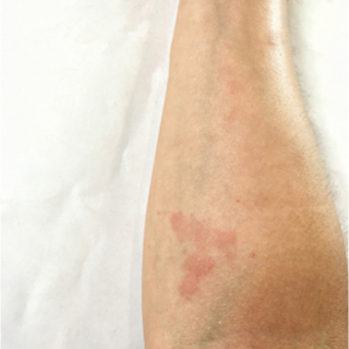 أسباب مرض الذئبة الحمراء أسباب مرض الذئبة الحمراء