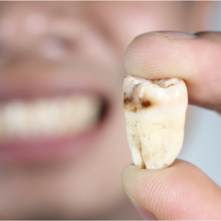 تسوس الأسنان تسوس الأسنان