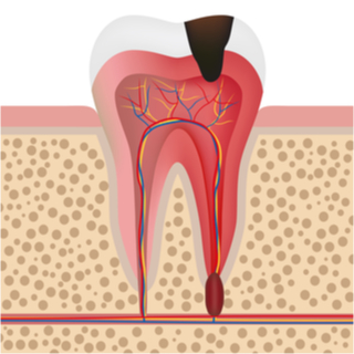 المرحلة الرابعة: تسوس اللب المرحلة الرابعة: تسوس اللب