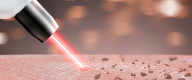 tbl_articles_article_25777_572f38c0384-7eec-41d4-b240-87c87fc1b079 تعرف على علاج الكلف طبيًا