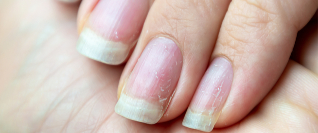 tbl_articles_article_26048_99645d517d7-0515-407f-b570-a505d08c4935 علاج تشقق الأظافر وأهم النصائح