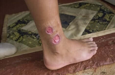 d8a7d984d984d98ad8b4d985d8a7d986d98ad8a7d8aa أعراض داء الليشمانيات