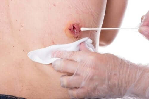 d8b9d984d8a7d8ac-d8a7d984d983d98ad8b3d8a7d8aa-d8a7d984d8a8d8b4d8b1d8a7d986d98ad8a9 علاج الكيسات البشرانية