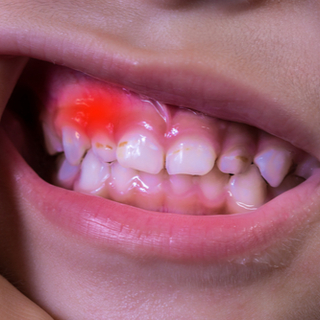 مقدمة حول أمراض اللثة بالصور مقدمة حول أمراض اللثة بالصور