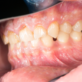 سبب حدوث أمراض اللثة سبب حدوث أمراض اللثة