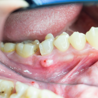 تعريف خراج الأسنان تعريف خراج الأسنان