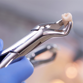 تركيب الأسنان تركيب الأسنان