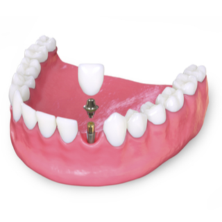 1. زراعة الأسنان 1. زراعة الأسنان