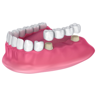 2. جسور الأسنان الثابتة 2. جسور الأسنان الثابتة