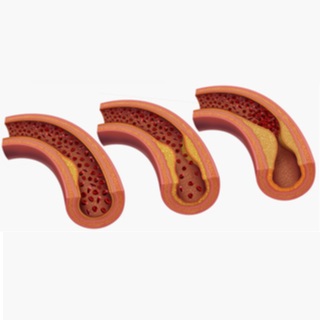 ما هو تصلب الشرايين؟ ما هو تصلب الشرايين؟