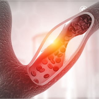أعراض تصلب الشرايين. أعراض تصلب الشرايين.