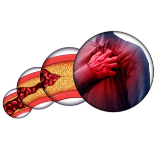 أعراض تصلب شرايين القلب. أعراض تصلب شرايين القلب.