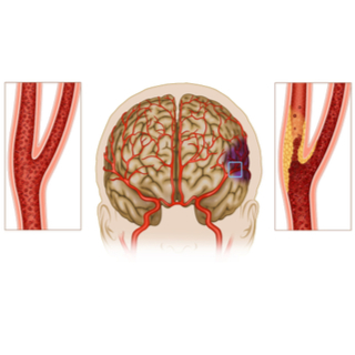 أعراض تصلب شرايين الدماغ. أعراض تصلب شرايين الدماغ.