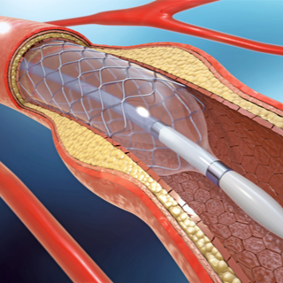 علاج تصلب الشرايين. علاج تصلب الشرايين.