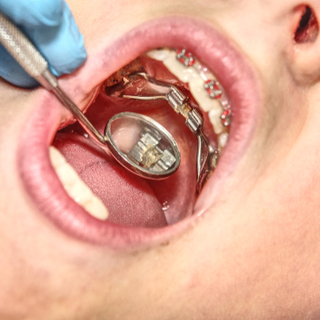 الموسعات الحنكية الموسعات الحنكية