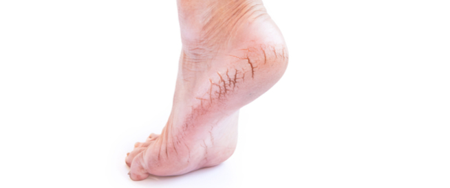 tbl_articles_article_26700_223b8d75815-ca8f-4f9b-b3dd-d872bcad5987 علاج تشقق القدمين بالخل: هل هو فعّال؟