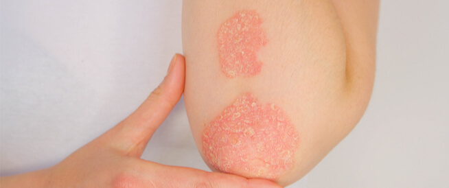 tbl_articles_article_26784_85342ab0a5d-d2c4-4e4f-a3f2-980558df9a89 هل الصدفية تسبب العقم؟ إليك الإجابة