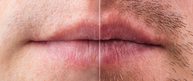 tbl_articles_article_27174_9436b000312-7b42-44cd-a7d8-04dbaf5a6922 كل ما يهمك معرفته عن زراعة اللحية