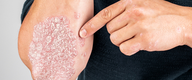 tbl_articles_article_27187_503a25f322a-3d03-4526-9b93-050094b03d3a الصدفية اللويحية: أنواع وعلاجات