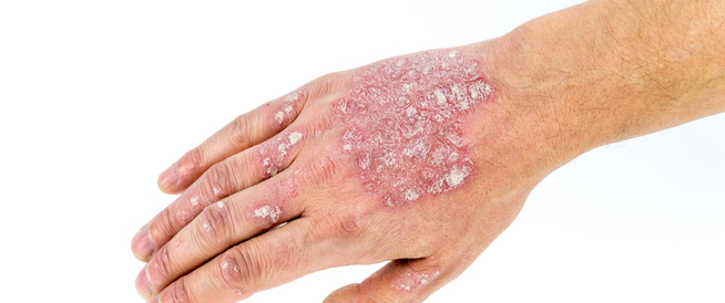 tbl_articles_article_27188_648d44513cf-a6df-4ead-a19d-3e54a2067c2d الصدفية البثرية: دليلك الشامل