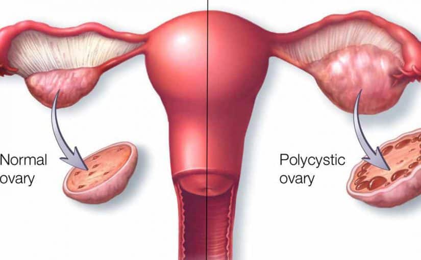 d8aad983d98ad8b3-d8a7d984d985d8a8d8a7d98ad8b6-825x510-2 كيفية علاج تكيس المبايض