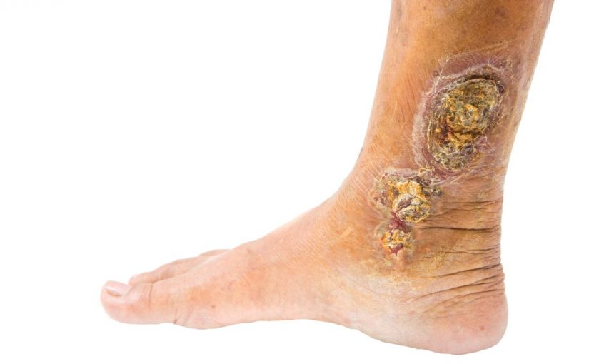 d8b9d984d8a7d8ac-d8a7d984d8afd988d8a7d984d98a-825x510-2 علاج الدوالي بالاعشاب والزيوت