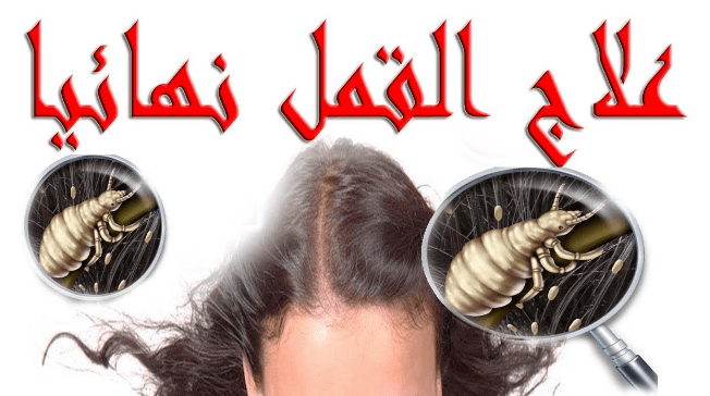 علاج القمل والصيبان بالطب النبوي