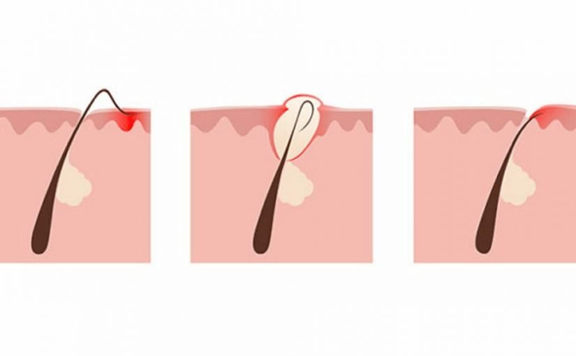 d8b9d984d8a7d8ac-d8b4d8b9d8b1-d8aad8add8aa-d8a7d984d8acd984d8af-825x510-2 علاج شعر تحت الجلد