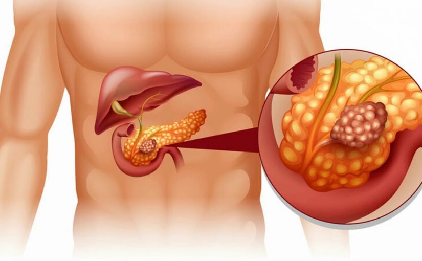 d985d8b1d8b6-d985d8aad984d8a7d8b2d985d8a9-d8b2d988d984d98ad986d8acd8b1-d8a5d984d98ad8b3d988d986-zollinger-ellison-syndrome-825x510-2 مرض متلازمة زولينجر إليسون zollinger ellison syndrome