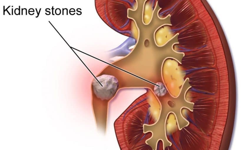 kidney-stones-825x510-2 حصى الكلى