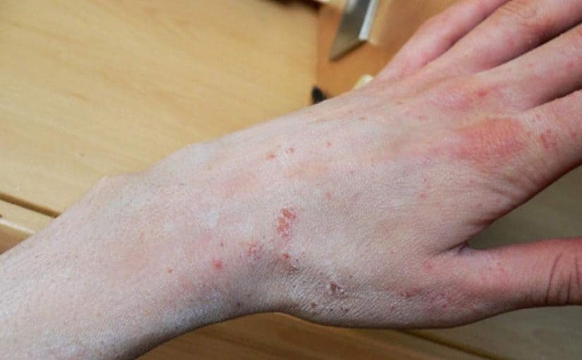 priznaki-chesotki1-825x510-2 علاج الجرب مجرب