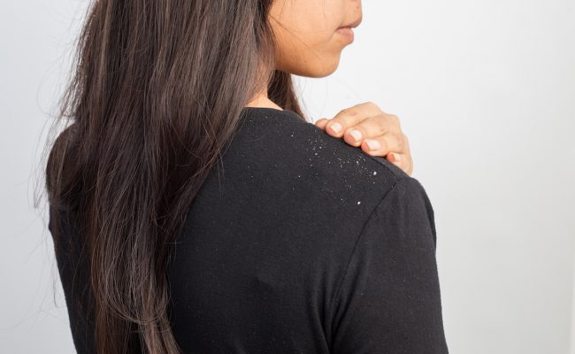 علاج القشرة بالطرق الطبيعية في المنزل