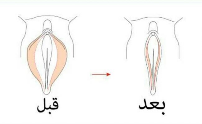 متى اسوي عملية تضييق المهبل بعد الولادة