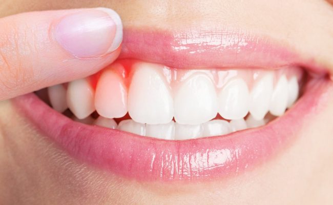 علاج التهاب اللثه بالمره لوقف النزيف